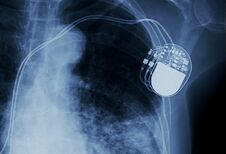 Moeten hartpatiënten met een pacemaker oppassen bij het opladen van hun elektrische auto?